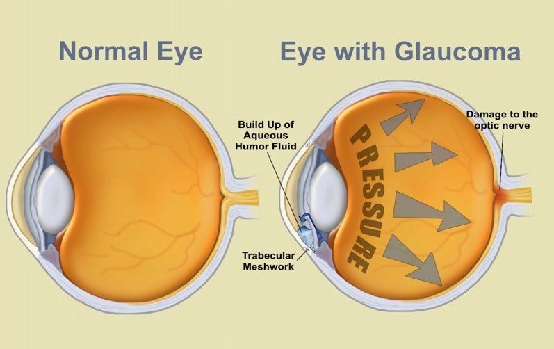 Glaucoma