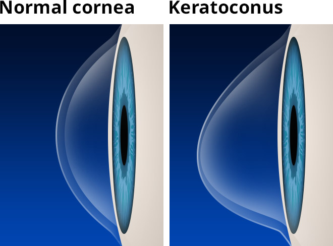 keratoconus-with-labels-660×488