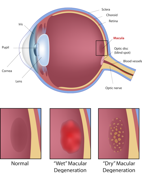 macular-degeneration