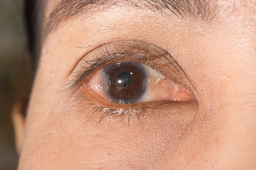 pterygium eye disease