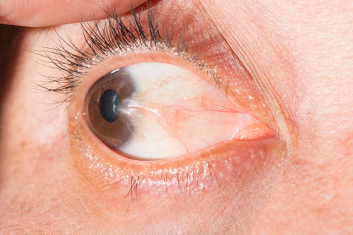 pterygium eye disease