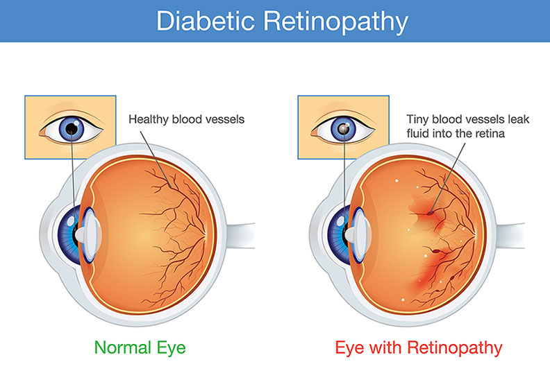 Diabetic Retinopathy Symptoms Treatment Lsc Eye Clinic