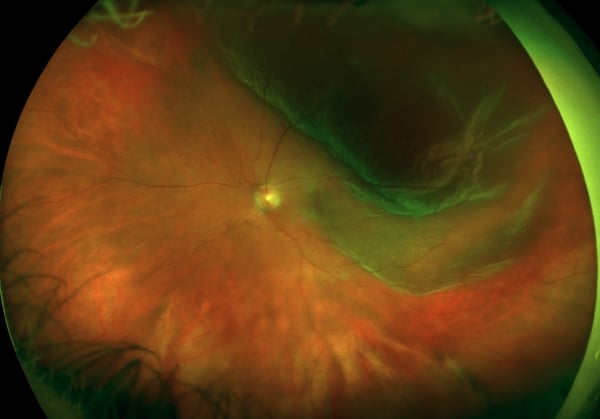 retinal detachment treatment