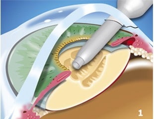 Cataracts-Treated-img1