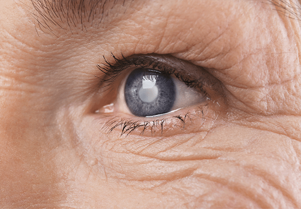 cataract surgery in singapore