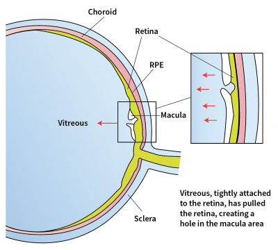 Macular Hole Illustration