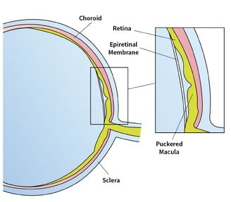 Epiretinal Membrane