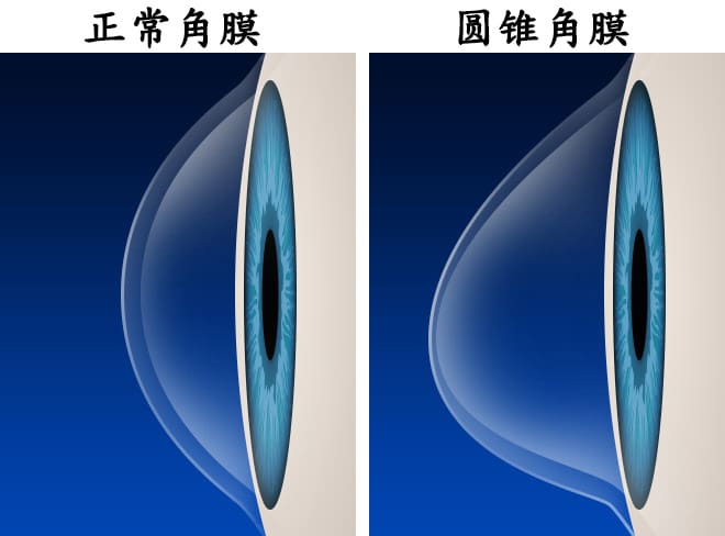 keratoconus-with-labels-660×488