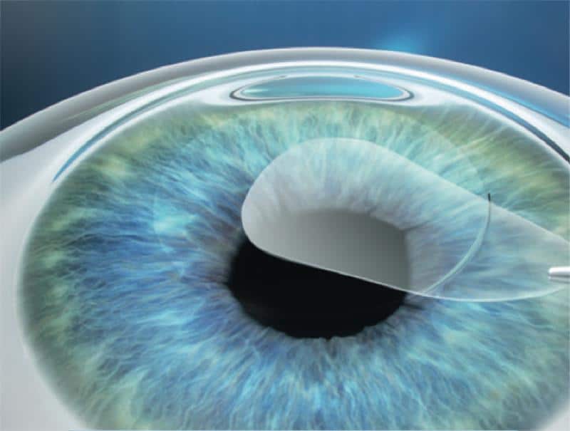 Lenticule Removal