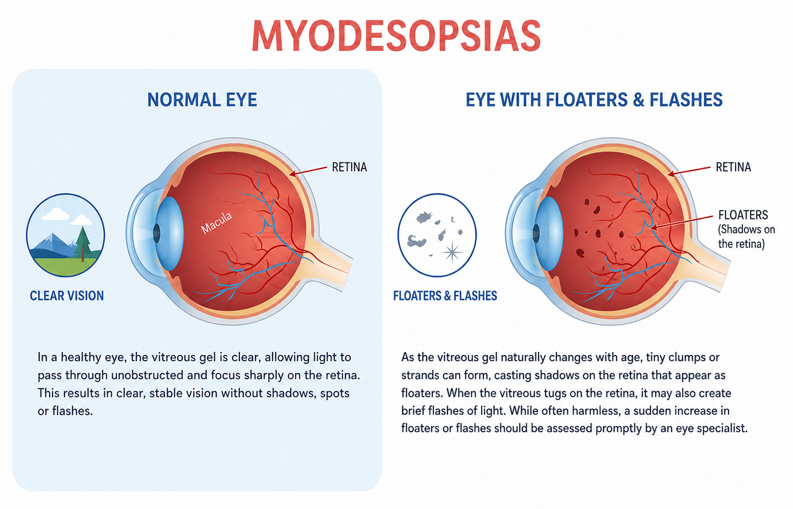 myodesopsias