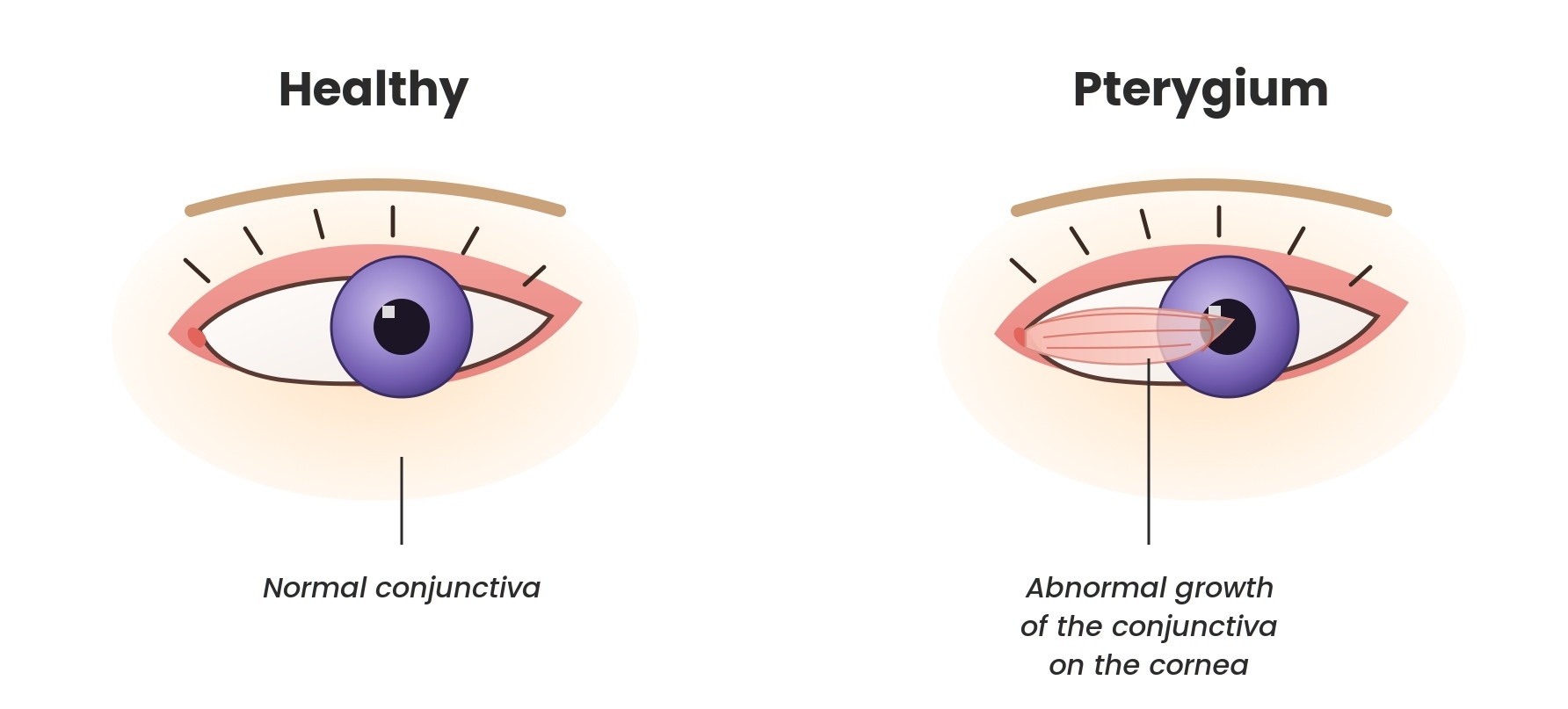 LSC_Pterygium_Illustration (1)