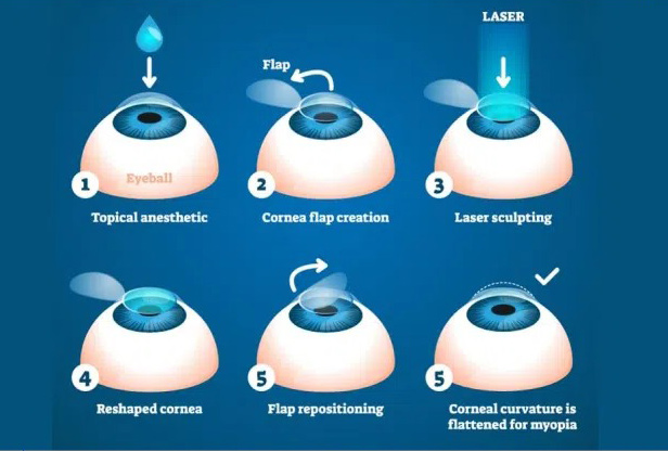 lasik-vs-prk
